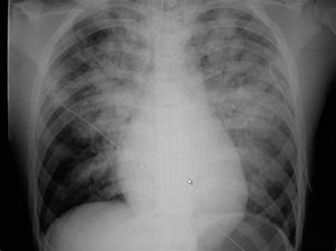 kardiomegali tanpa bendungan paru